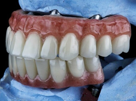 Implant-supported Dentures in Benalla for Lasting Comfort - Sonstige
