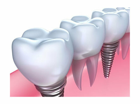 Affordable Dental Implants Cost in Sydney - Khác