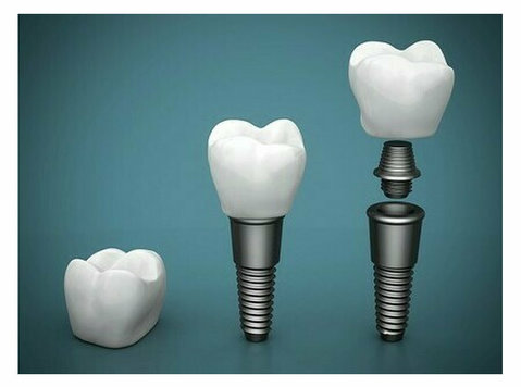 Digital Dental Implants Sydney | To make your Dream Smile - Muu