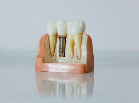 Expert Care for Missing Teeth – Dental Implants in Sydney - อื่นๆ