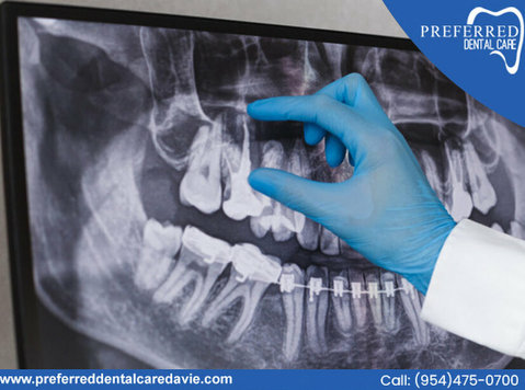 Relieve Pain with Expert Root Canal Near Me In Davie - Iné