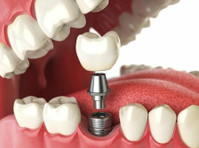 Transform Your Smile with Dental Implants at Just $999! - Moda/Beleza