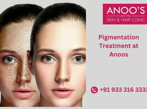 Advanced Pigmentation Treatment at Anoos - Krása a móda