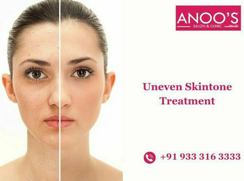 Advanced Uneven Skin Tone Treatment at Anoos - Kauneus/Muoti