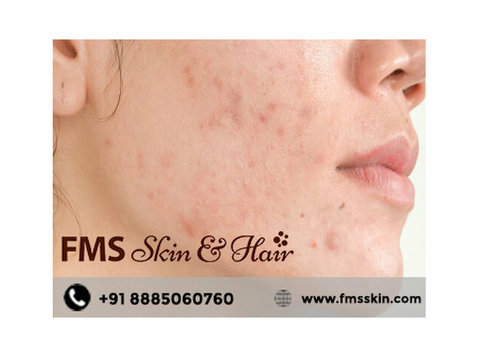 Best Acne Scar Treatment In Kondapur Hyderabad - زیبایی‌ / مد