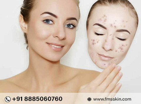 Best Acne Treatment Clinic In Kondapur Hyderabad - Beauty/Fashion