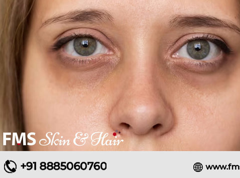 Best Dark Circle Removal Treatment In Hyderabad - Beauty/Fashion
