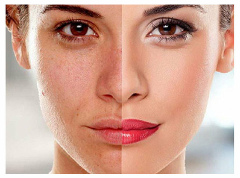 Best Laser Skin Whitening Treatment In Kondapur Hyderabad - Moda/Beleza