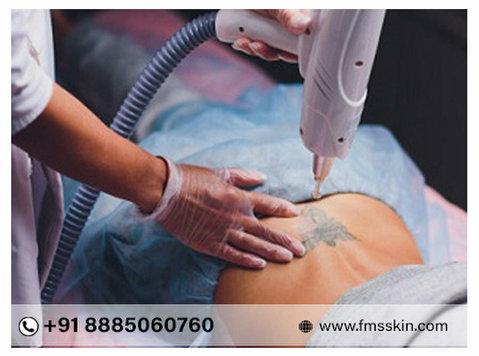 Best Tattoo Removal Laser treatment in Kondapur Hyderabad - Frumuseţe/Moda