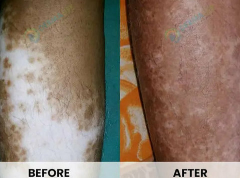Effective Vitiligo Treatment in Delhi : Revitalize Your Skin - Moda/Beleza