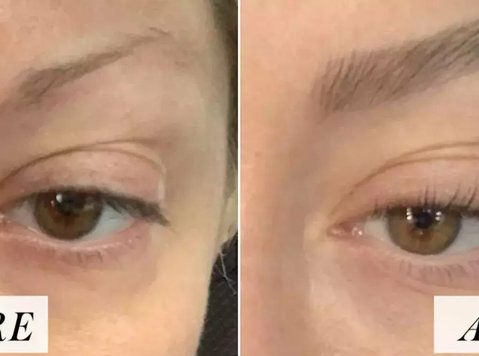 Eyebrow Lift Surgery In Lucknow - Beauty/Fashion
