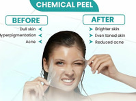 Say Goodbye to Stubborn Scars – Expert Acne Scar Removal in - Красота/мода