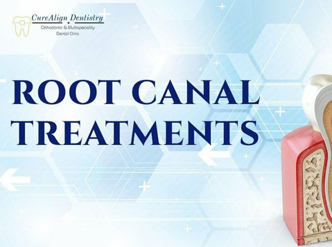 Best Root Canal Treatment in Hennur, Bangalore — Curealign D - Iné