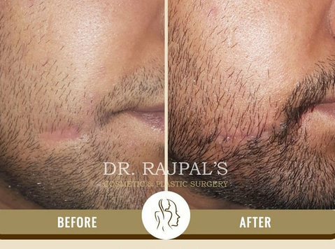 Smooth Out Imperfections with Scar Removal Treatment in Delh - อื่นๆ