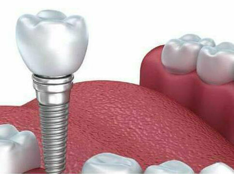 The Best Dental Implants Services in Delhi - Services: Other