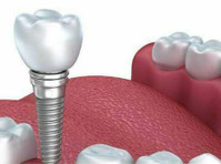 The Best Dental Implants Services in Delhi - Overig