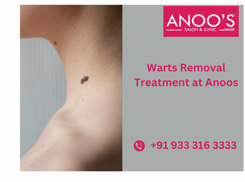 Advanced Warts Removal Treatment at Anoos - Krása a móda