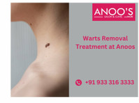 Advanced Warts Removal Treatment at Anoos - 뷰티/패션