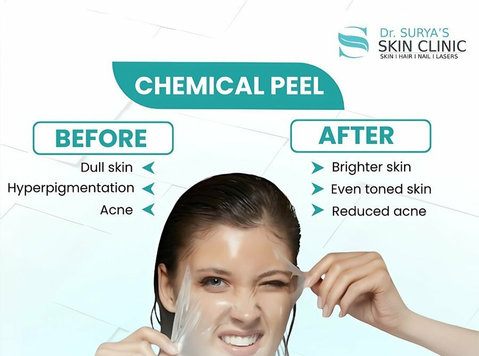 Pigmentation Treatment in Secunderabad - Beauty/Fashion