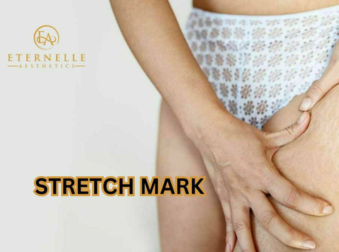 Stretch Mark Removal Treatment In Hyderabad - Eternelle Aest - Moda/Beleza
