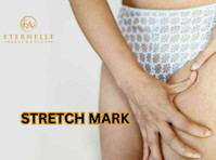 Stretch Mark Removal Treatment In Hyderabad - Eternelle Aest - Kauneus/Muoti