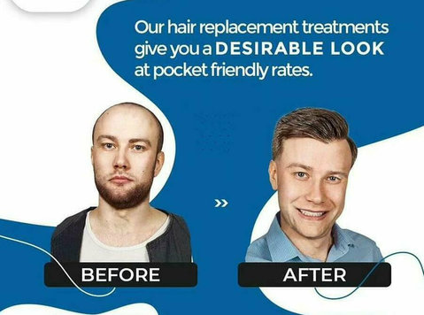 non-surgical hair replacement in kukatpally Hyderabad - 뷰티/패션