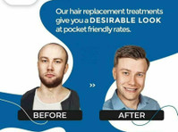 non-surgical hair replacement in kukatpally Hyderabad - Beauty/Fashion