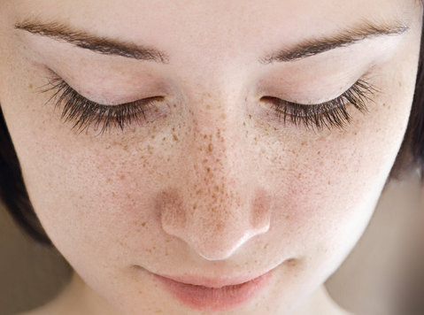 Best Freckles Treatment in Hyderabad - Inne