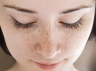 Best Freckles Treatment in Hyderabad - Services: Other