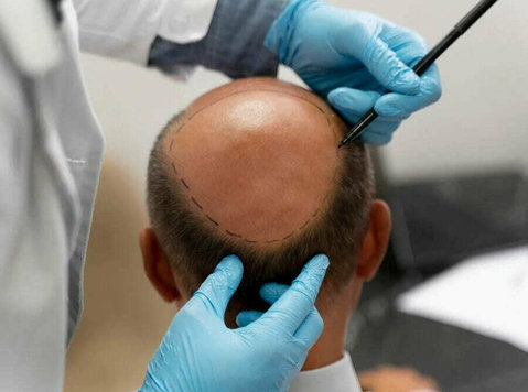 Best Hair Transplantation In Hyderabad - Övrigt