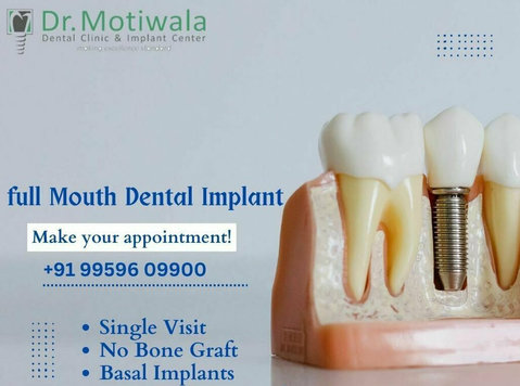 Full Mouth Dental Implants Cost - Muu