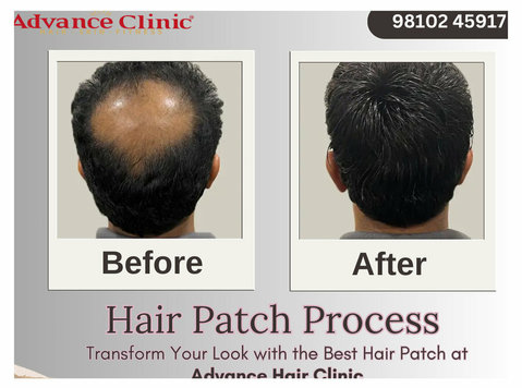 Advance Hair Clinic: Hair Extensions, Hair Patch, Toppers. - Друго