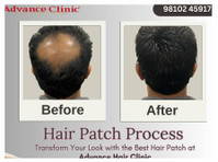 Advance Hair Clinic: Hair Extensions, Hair Patch, Toppers. - Muu