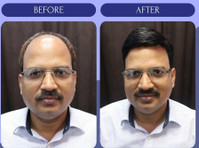 Hair Replacement - wigs & Patch Fixing in Noida - Buy & Sell: Other