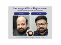 Hair Replacement - wigs & Patch Fixing in Noida - Overig