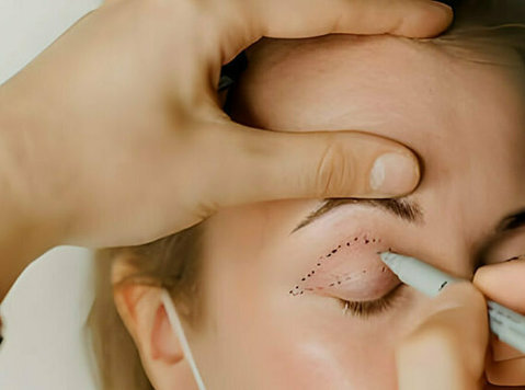 Comprehensive Guide to Eyelid Surgery in Delhi - Ljepota/moda
