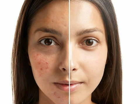 Erase the Marks: Advanced Acne Scar Treatment in Delhi - Bellezza/Moda