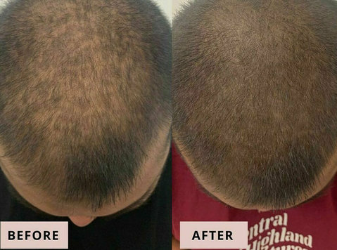 GFC Treatment for a magic results for hair growth - Beauty/Fashion