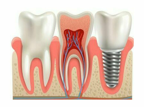 Best dental implant treatment in East of Kailash - Muu