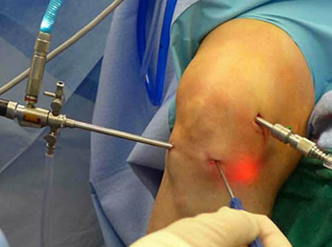 Dr. Shekhar Srivastav: Expert in Arthroscopic Knee Surgery i - Iné