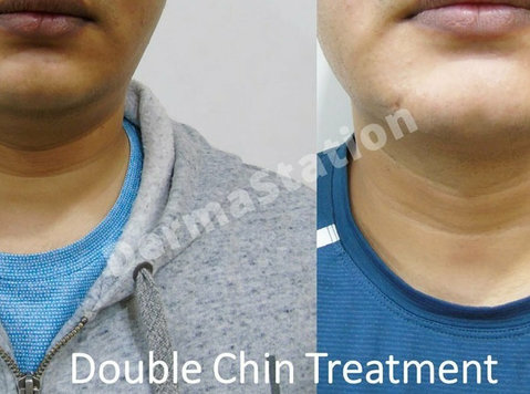 Effective Double Chin Treatment in Delhi by Experts - Services: Other