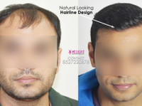 Get the Best Hair Transplant in Delhi at Medispa India - Sonstige