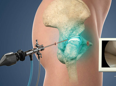 Make an Appointment of Best Arthroscopic Surgeon in Delhi - Outros