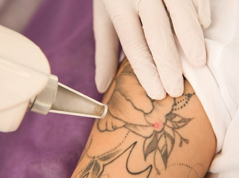Tattoo removal treatment in dwarka - Annet