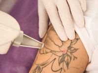 Tattoo removal treatment in dwarka - Drugo