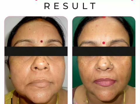 Hifu Treatment for Face: Non-surgical Skin Tightening - Ilu/Mood