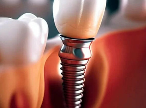 Discover the Cost of Dental Implants in Ahmedabad - Community: Other