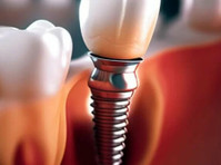 Discover the Cost of Dental Implants in Ahmedabad - อื่นๆ