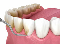 Discoloration of Teeth - Clean Up Those Discolored Teeth - Skjønnhet/Mote