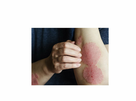 Psoriasis Specialist Doctor in Ahmedabad, Gujarat - Beauty/Fashion